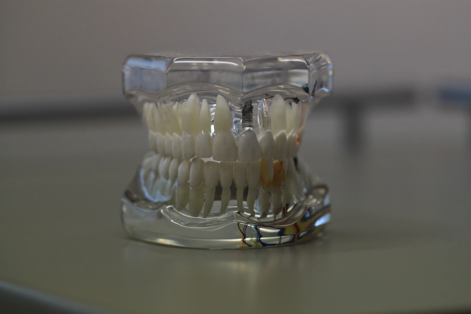 En este momento estás viendo Implantes dentales bajo el agua